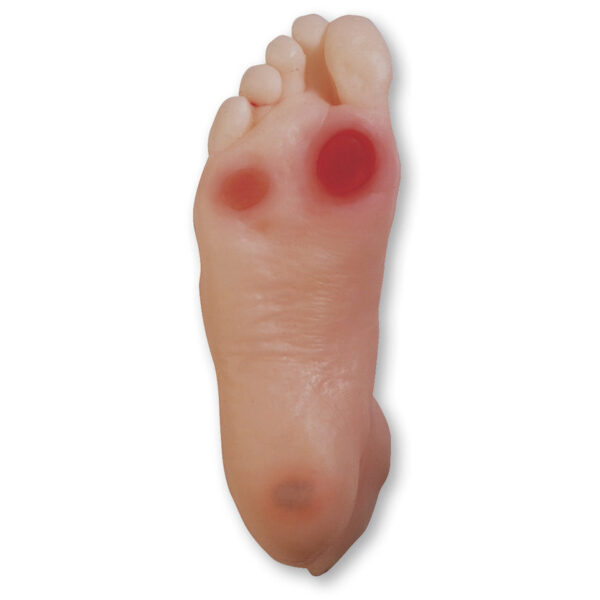 Nasco Diabetic Foot Model