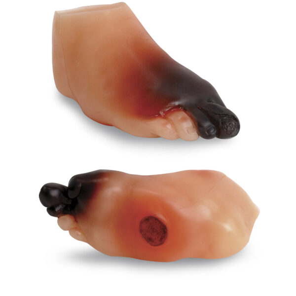 Nasco Severe Diabetic Foot Model