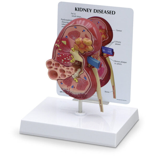 Nasco Kidney Model with Pathologies