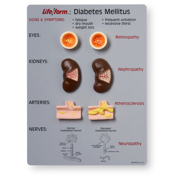 Nasco Life form Diabetes Mellitus Teaching Kit [SKU: WA20495]